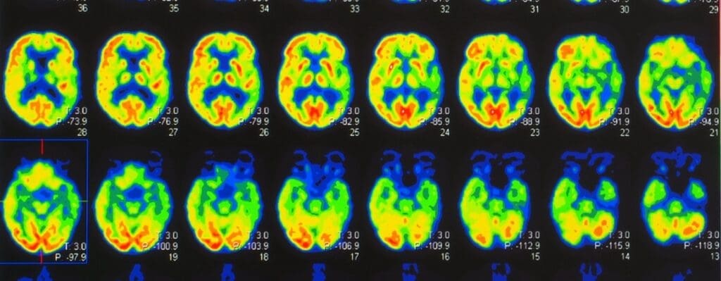Dynamic Susceptibility Contrast-Enhanced Perfusion Mr Scan